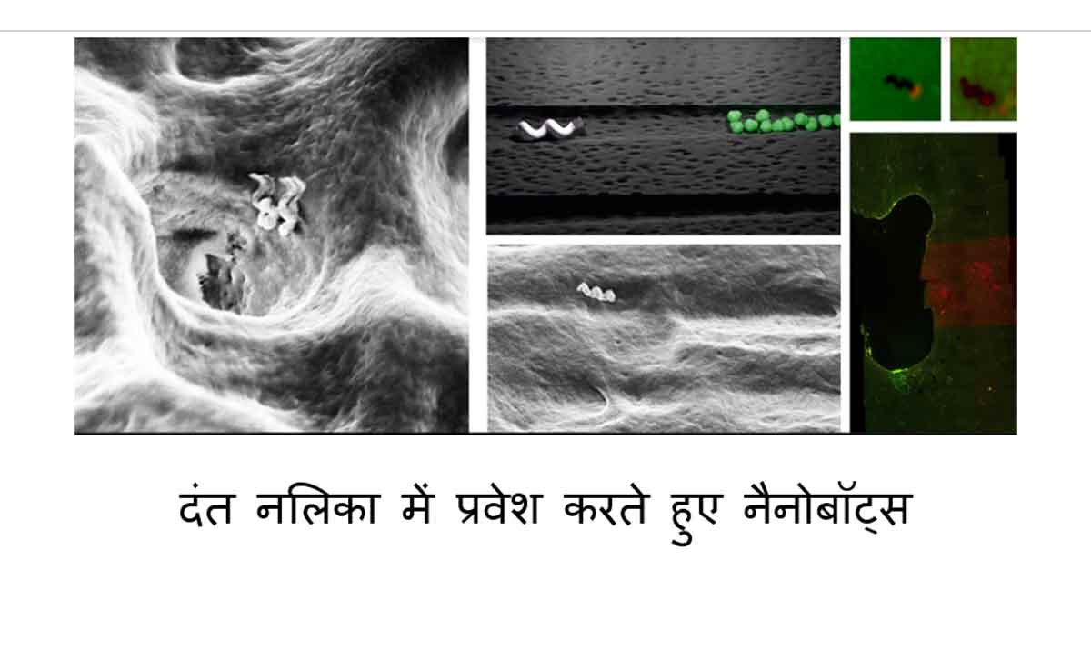 दाँतों के बेहतर उपचार में मदद करेंगे स्वदेशी नैनो रोबोट