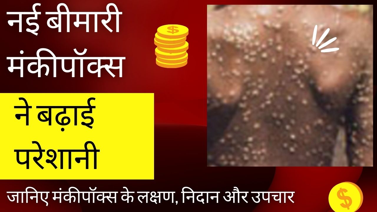 नई बीमारी मंकीपॉक्स ने बढ़ाई विशेषज्ञों की परेशानी, जानिए मंकीपॉक्स के लक्षण, निदान और उपचार