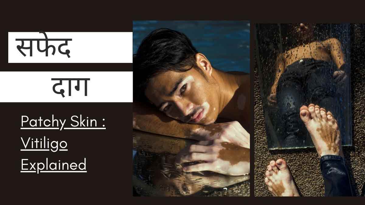 जानें क्या होता है विटिलिगो, कितना घातक है और क्या है विटिलिगो का उपचार