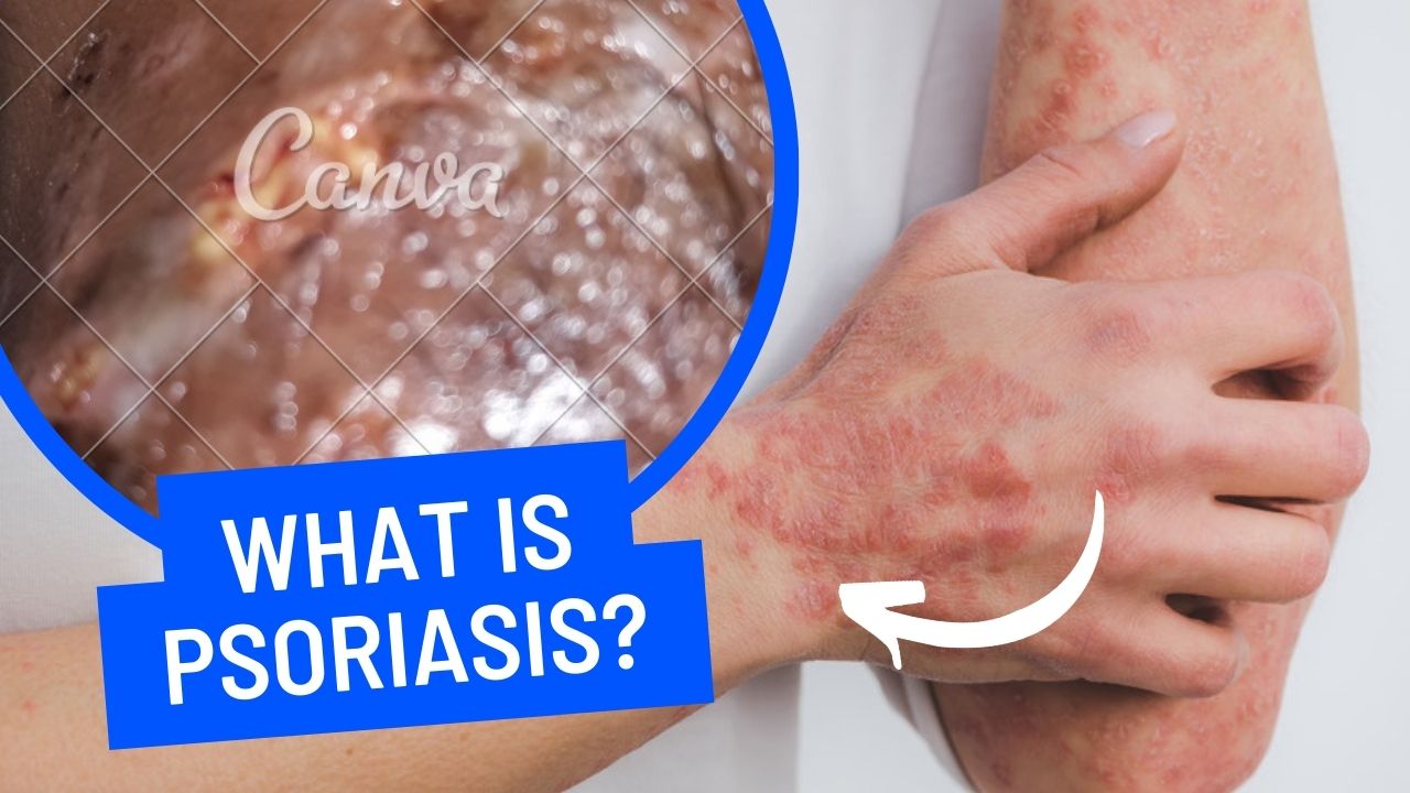 What is psoriasis सोरायसिस क्या है?