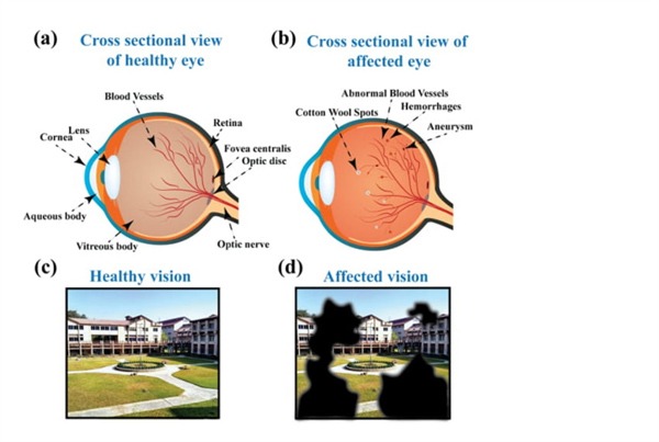 डायबिटिक रेटिनोपैथी का पता लगाने लिए नया उपकरण