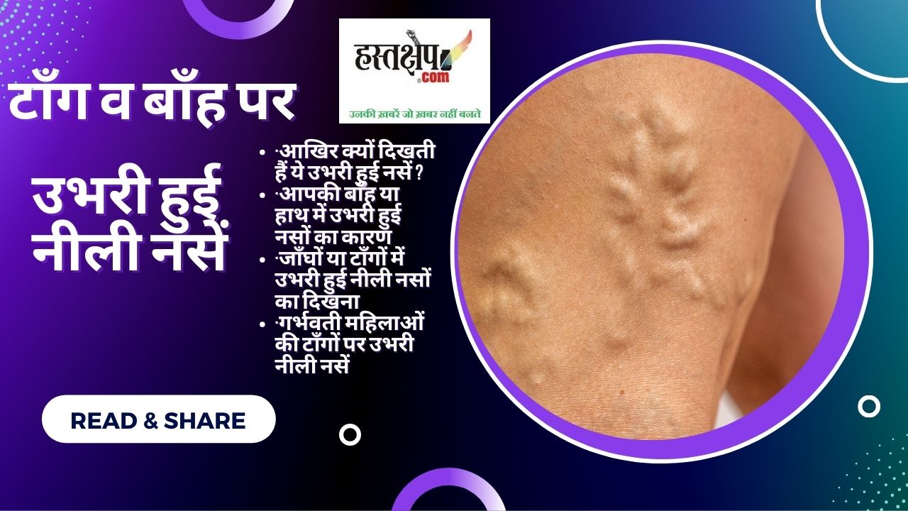 टाँग व बाँह पर उभरी हुई नीली नसें : लापरवाही न बरतें