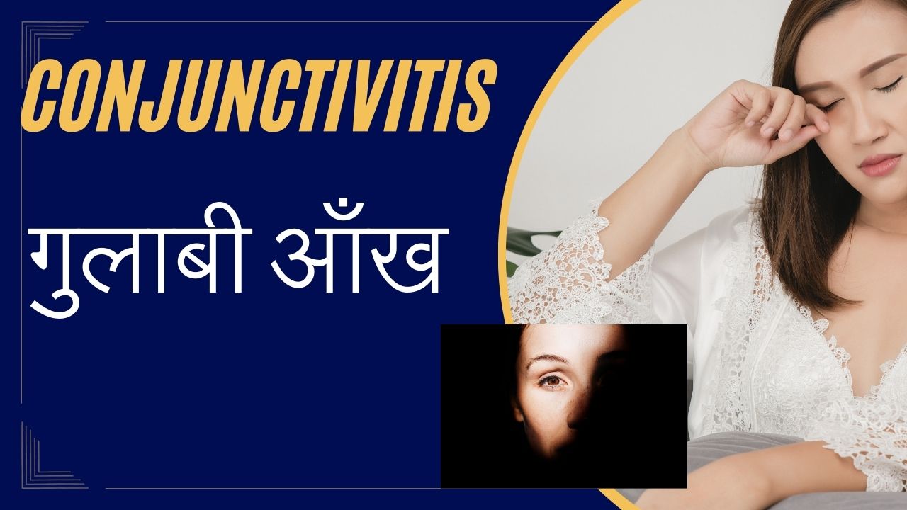गुलाबी आँख कंजक्टिवाइटिस: कारण, लक्षण एवं उपचार की संपूर्ण जानकारी