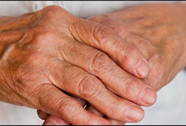 रूमेटाइड अर्थराइटिस की जांच के लिए टेस्ट Tests to diagnose rheumatoid arthritis