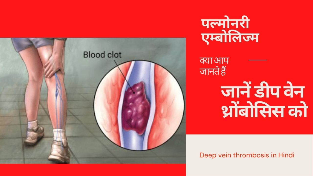 जानें डीप वेन थ्रोंबोसिस को