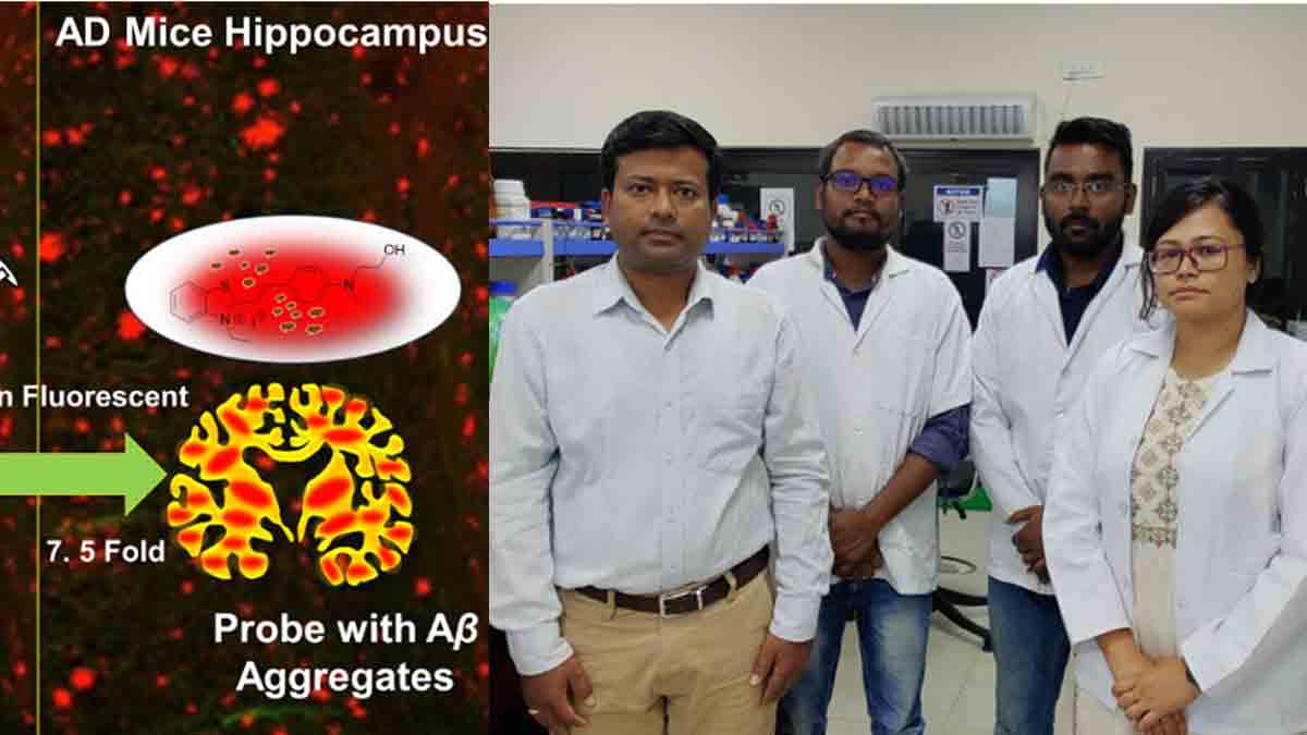 अल्जाइमर का निदान : शोधकर्ताओं ने विकसित किया नया परीक्षण