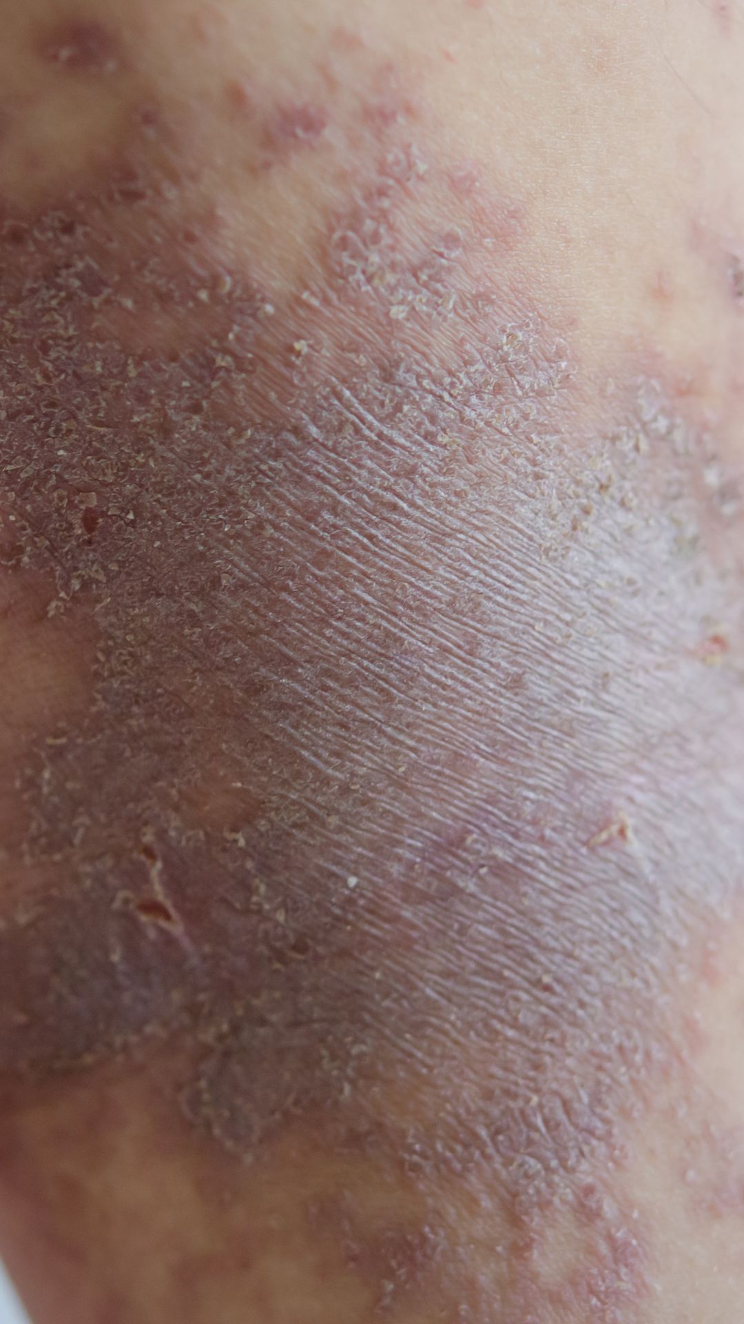 ड्रग एलर्जी : जानिए कैसे करें प्रबंधन